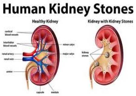சிறுநீரக கற்கள் வரவிடாமல் தடுக்க…