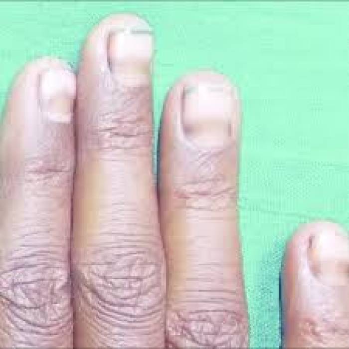 நகத்தின் கருமை மறைய...